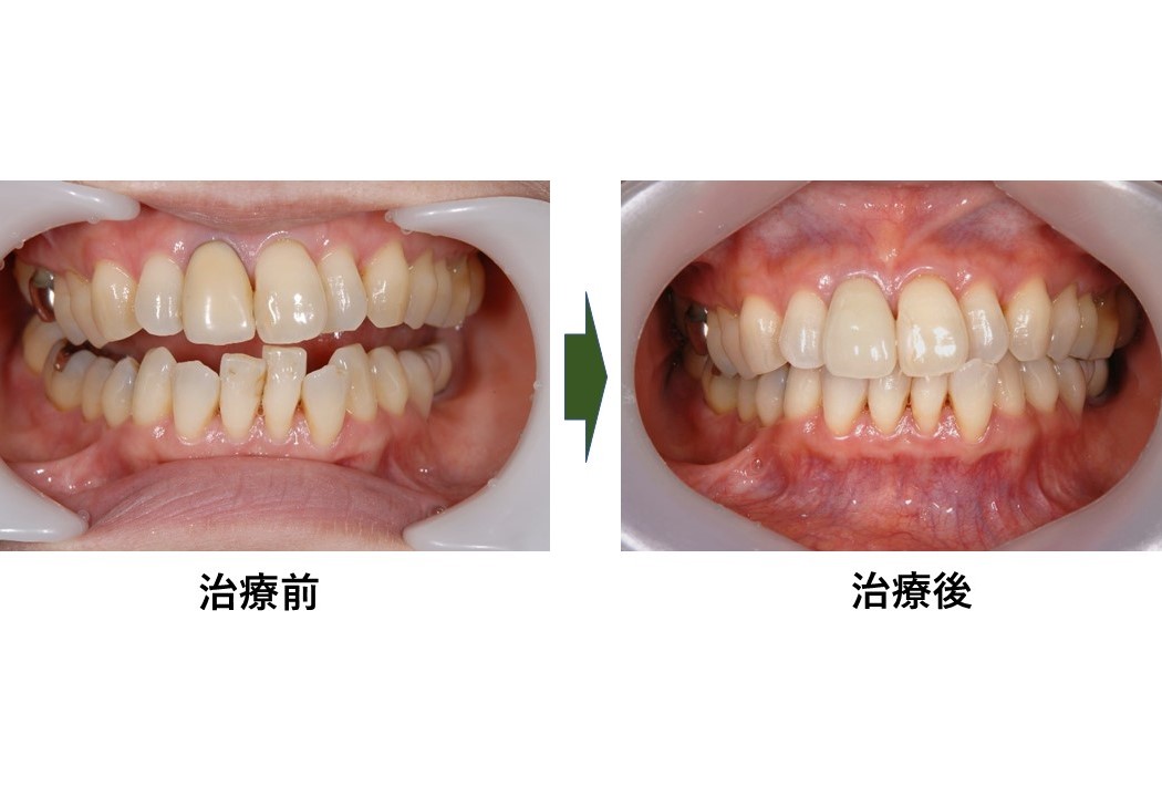 症例 黒ずんだ歯茎の改善を図った審美修復 馬車道アイランドタワー歯科 馬車道駅直結の歯医者