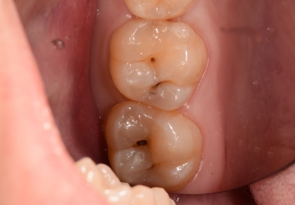 虫歯の早期発見で有効な治療「コンポジットレジン修復」について
