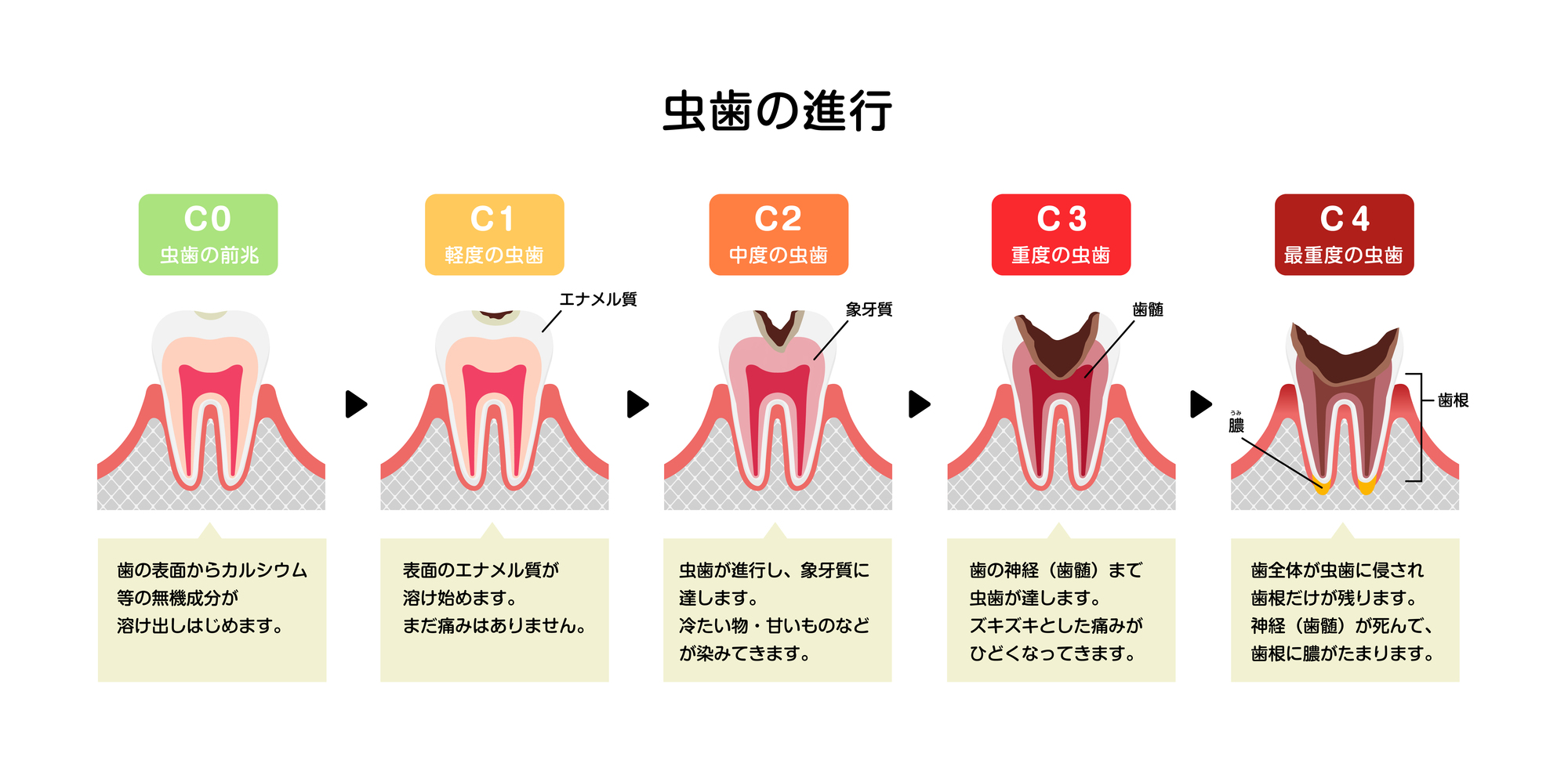 虫歯の早期発見で有効な治療「コンポジットレジン修復」について