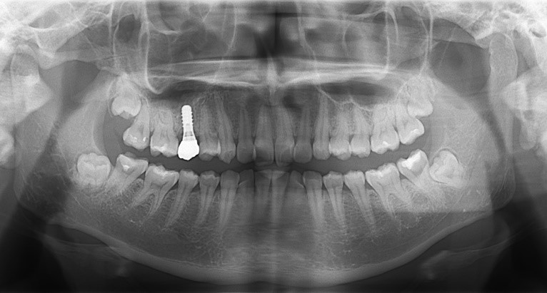 【症例】抜歯と同時にインプラントを行う、抜歯即時埋入インプラント