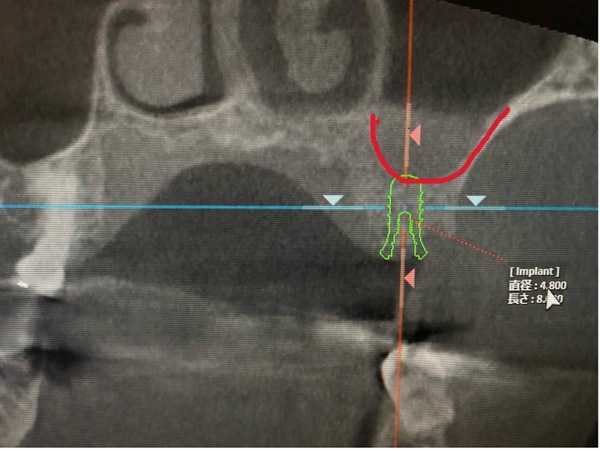 馬車道アイランドタワー歯科｜【症例】上顎部の骨が足りない部分へソケットリフトを行いインプラントを埋入した症例｜骨の状態を調べるCT画像２