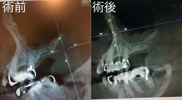 馬車道アイランドタワー歯科｜【症例】咬み合わせの崩れをインプラントを用いて修復｜術前・術後