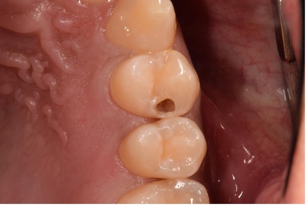 馬車道アイランドタワー歯科｜【症例】深い虫歯に対しMTAセメントを用い神経を残した症例｜治療前口腔内写真穴開け